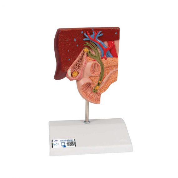 Gallstone Model - 3B Smart Anatomy