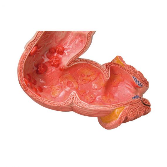 Intestinal Diseases Model - 3B Smart Anatomy..