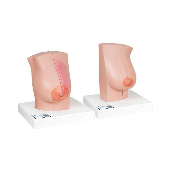 Model of Female Breast with Healthy & Unhealthy Tissue - 3B Smart Anatomy