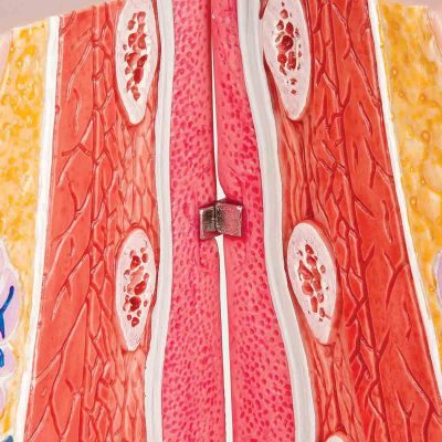 Model of Female Breast with Healthy & Unhealthy Tissue - 3B Smart Anatomy........