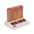 Skin Cancer Model with 5 stages, 8 times magnified - 3B Smart Anatomy..