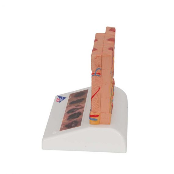 Skin Cancer Model with 5 stages, 8 times magnified - 3B Smart Anatomy....