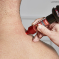 laser-therapy-treatment-300x200