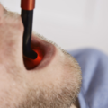 laser-treatment-wounds-detnal-use-300x208