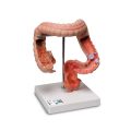 Intestinal Diseases Model - 3B Smart Anatomy