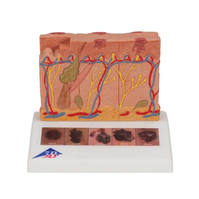 Skin Cancer Model with 5 stages, 8 times magnified - 3B Smart Anatomy