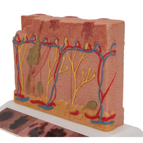 Skin Cancer Model with 5 stages, 8 times magnified - 3B Smart Anatomy......